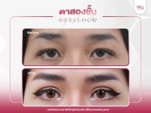 ภาพก่อนหลังทำตาสองชั้น , ภาพก่อนหลังแก้ตาสองชั้น