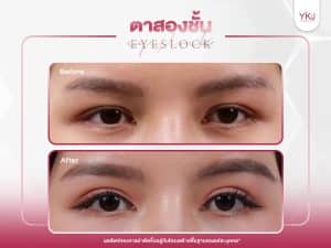 ภาพก่อนหลังทำตาสองชั้น , ภาพก่อนหลังแก้ตาสองชั้น