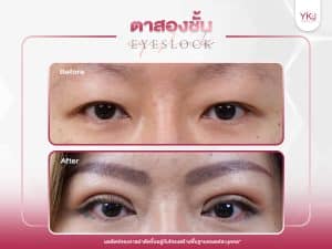 ภาพก่อนหลังทำตาสองชั้น , ภาพก่อนหลังแก้ตาสองชั้น