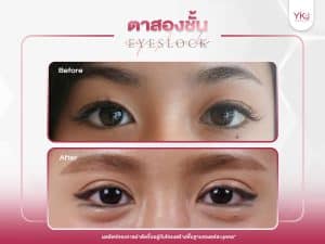 ภาพก่อนหลังทำตาสองชั้น , ภาพก่อนหลังแก้ตาสองชั้น