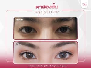 ภาพก่อนหลังทำตาสองชั้น , ภาพก่อนหลังแก้ตาสองชั้น