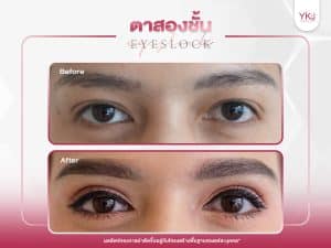ภาพก่อนหลังทำตาสองชั้น , ภาพก่อนหลังแก้ตาสองชั้น