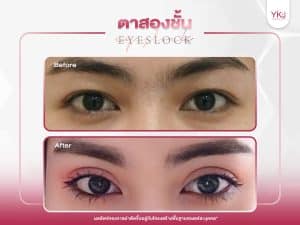 ภาพก่อนหลังทำตาสองชั้น , ภาพก่อนหลังแก้ตาสองชั้น