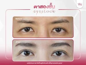 ภาพก่อนหลังทำตาสองชั้น , ภาพก่อนหลังแก้ตาสองชั้น