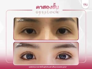 ภาพก่อนหลังทำตาสองชั้น , ภาพก่อนหลังแก้ตาสองชั้น
