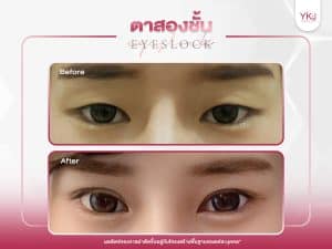 ภาพก่อนหลังทำตาสองชั้น , ภาพก่อนหลังแก้ตาสองชั้น