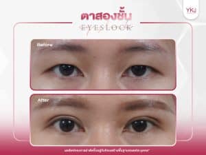 ภาพก่อนหลังทำตาสองชั้น , ภาพก่อนหลังแก้ตาสองชั้น