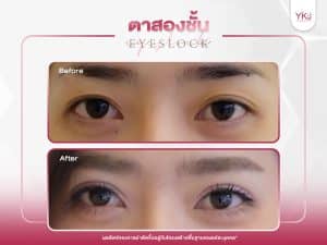ภาพก่อนหลังทำตาสองชั้น , ภาพก่อนหลังแก้ตาสองชั้น