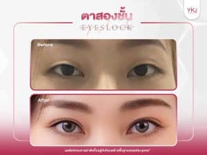 ภาพก่อนหลังทำตาสองชั้น , ภาพก่อนหลังแก้ตาสองชั้น