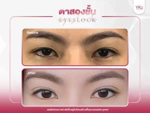 ภาพก่อนหลังทำตาสองชั้น , ภาพก่อนหลังแก้ตาสองชั้น