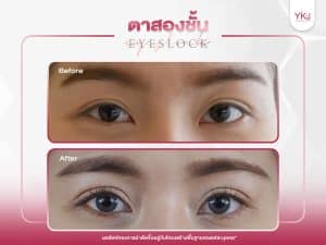 ภาพก่อนหลังทำตาสองชั้น , ภาพก่อนหลังแก้ตาสองชั้น