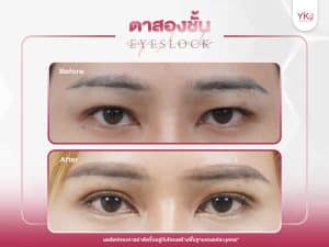 ภาพก่อนหลังทำตาสองชั้น , ภาพก่อนหลังแก้ตาสองชั้น