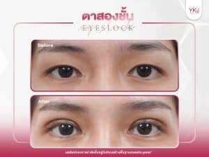 ภาพก่อนหลังทำตาสองชั้น , ภาพก่อนหลังแก้ตาสองชั้น