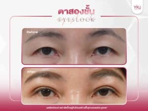 ภาพก่อนหลังทำตาสองชั้น , ภาพก่อนหลังแก้ตาสองชั้น