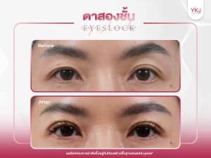 ภาพก่อนหลังทำตาสองชั้น , ภาพก่อนหลังแก้ตาสองชั้น