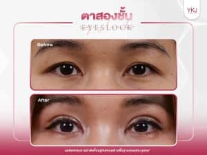 ภาพก่อนหลังทำตาสองชั้น , ภาพก่อนหลังแก้ตาสองชั้น