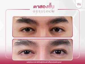 ภาพก่อนหลังทำตาสองชั้น , ภาพก่อนหลังแก้ตาสองชั้น