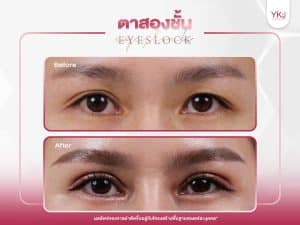 ภาพก่อนหลังทำตาสองชั้น , ภาพก่อนหลังแก้ตาสองชั้น