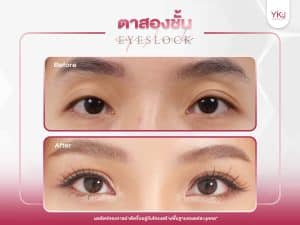 ภาพก่อนหลังทำตาสองชั้น , ภาพก่อนหลังแก้ตาสองชั้น