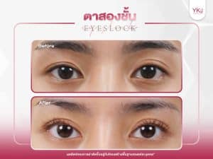 ภาพก่อนหลังทำตาสองชั้น , ภาพก่อนหลังแก้ตาสองชั้น