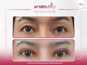 ภาพก่อนหลังทำตาสองชั้น , ภาพก่อนหลังแก้ตาสองชั้น