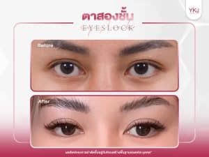 ภาพก่อนหลังทำตาสองชั้น , ภาพก่อนหลังแก้ตาสองชั้น