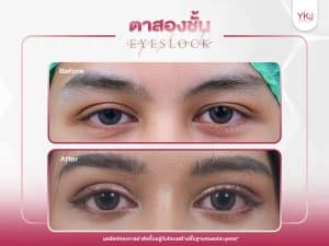 ภาพก่อนหลังทำตาสองชั้น , ภาพก่อนหลังแก้ตาสองชั้น