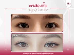 ภาพก่อนหลังทำตาสองชั้น , ภาพก่อนหลังแก้ตาสองชั้น