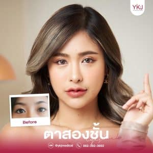 ก่อนหลังตาสองชั้น