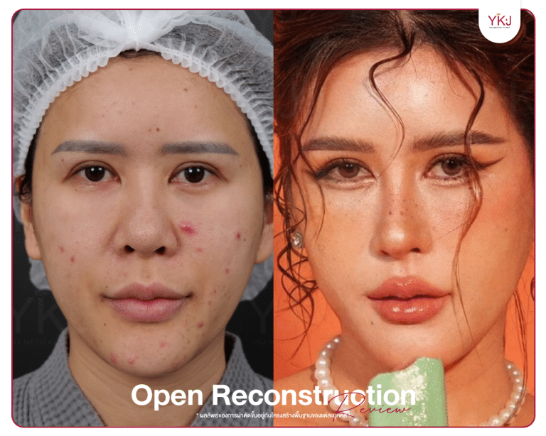 รีวิวแก้จมูก , รีวิวเสริมจมูกโอเพ่น , กระดูกซี่โครง , กระดูกอ่อนหลังหู