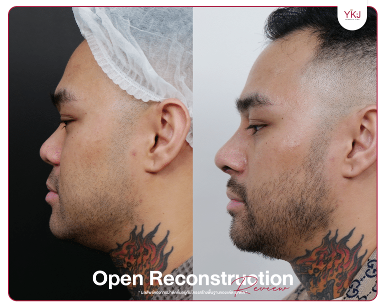 รีวิวแก้จมูก , รีวิวเสริมจมูกโอเพ่น , กระดูกซี่โครง , กระดูกอ่อนหลังหู
