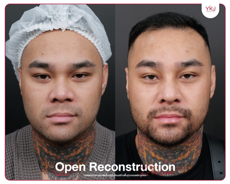 รีวิวแก้จมูก , รีวิวเสริมจมูกโอเพ่น , กระดูกซี่โครง , กระดูกอ่อนหลังหู
