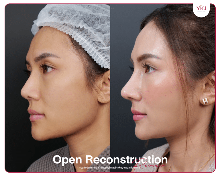 รีวิวแก้จมูก , รีวิวเสริมจมูกโอเพ่น , กระดูกซี่โครง , กระดูกอ่อนหลังหู