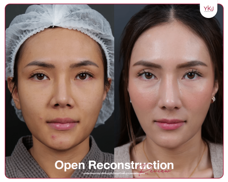 รีวิวแก้จมูก , รีวิวเสริมจมูกโอเพ่น , กระดูกซี่โครง , กระดูกอ่อนหลังหู