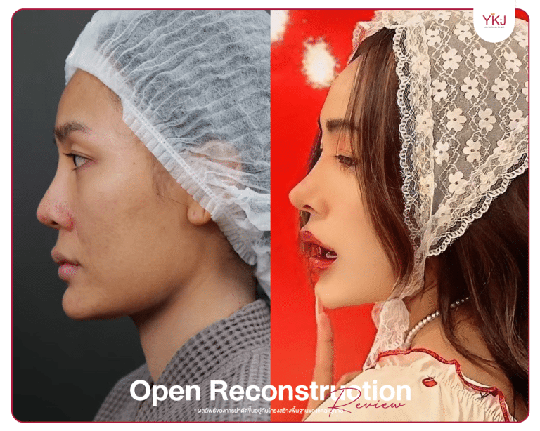 รีวิวแก้จมูก , รีวิวเสริมจมูกโอเพ่น , กระดูกซี่โครง , กระดูกอ่อนหลังหู