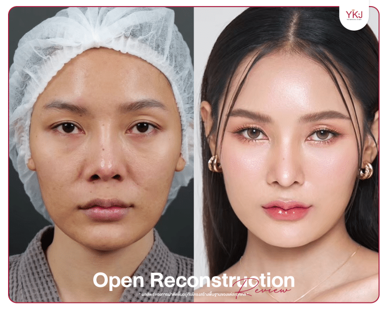 รีวิวแก้จมูก , รีวิวเสริมจมูกโอเพ่น , กระดูกซี่โครง , กระดูกอ่อนหลังหู