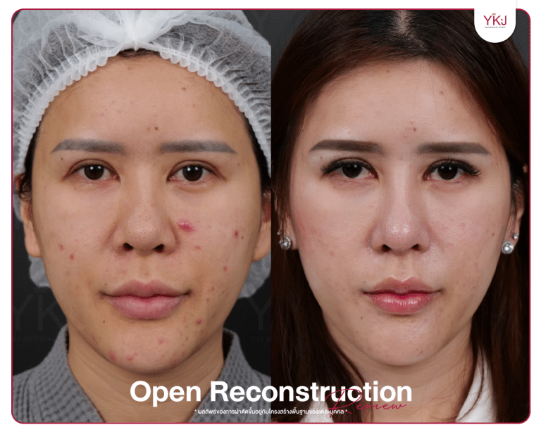 รีวิวแก้จมูก , รีวิวเสริมจมูกโอเพ่น , กระดูกซี่โครง , กระดูกอ่อนหลังหู