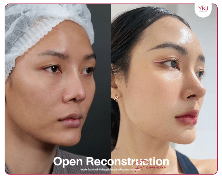 รีวิวแก้จมูก , รีวิวเสริมจมูกโอเพ่น , กระดูกซี่โครง , กระดูกอ่อนหลังหู