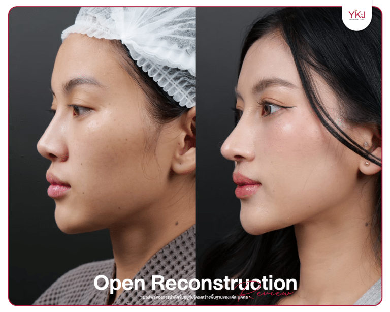 รีวิวแก้จมูก , รีวิวเสริมจมูกโอเพ่น , กระดูกซี่โครง , กระดูกอ่อนหลังหู