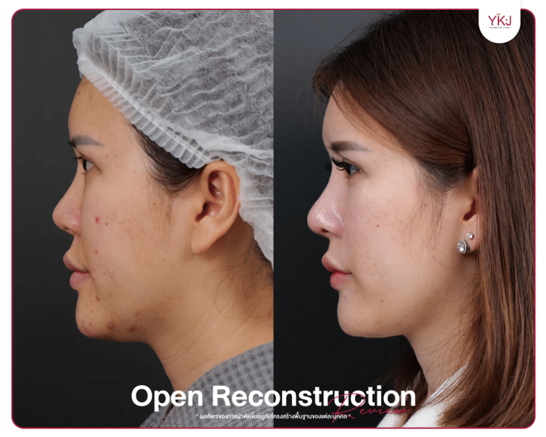 รีวิวแก้จมูก , รีวิวเสริมจมูกโอเพ่น , กระดูกซี่โครง , กระดูกอ่อนหลังหู