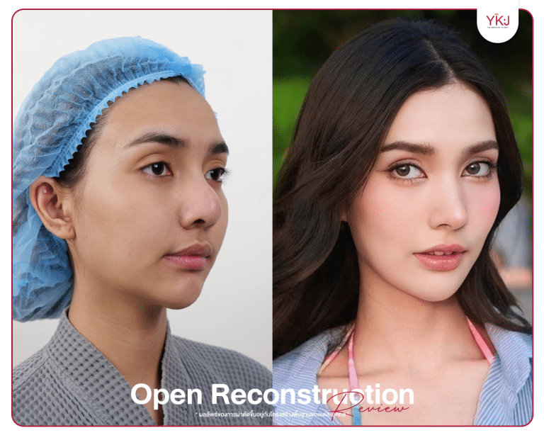 รีวิวแก้จมูก , รีวิวเสริมจมูกโอเพ่น , กระดูกซี่โครง , กระดูกอ่อนหลังหู