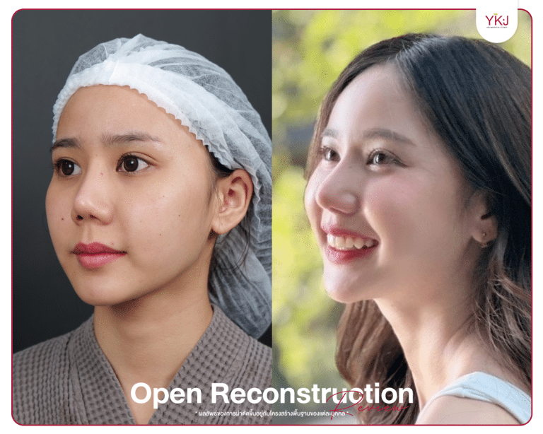 รีวิวแก้จมูก , รีวิวเสริมจมูกโอเพ่น , กระดูกซี่โครง , กระดูกอ่อนหลังหู