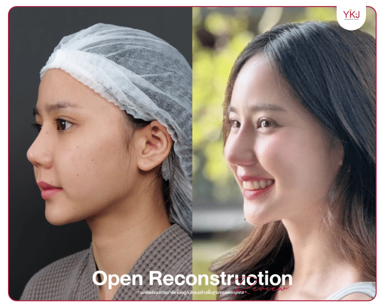 รีวิวแก้จมูก , รีวิวเสริมจมูกโอเพ่น , กระดูกซี่โครง , กระดูกอ่อนหลังหู