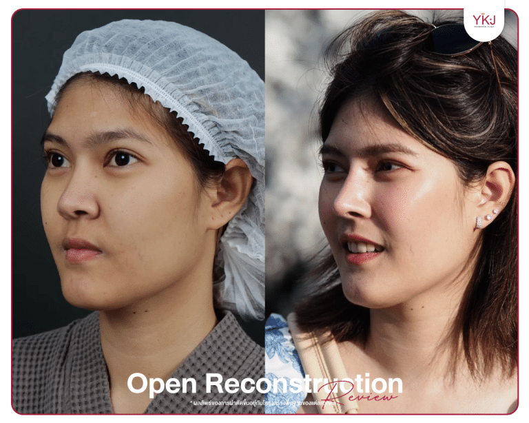 รีวิวแก้จมูก , รีวิวเสริมจมูกโอเพ่น , กระดูกซี่โครง , กระดูกอ่อนหลังหู