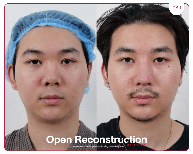 รีวิวแก้จมูก , รีวิวเสริมจมูกโอเพ่น , กระดูกซี่โครง , กระดูกอ่อนหลังหู