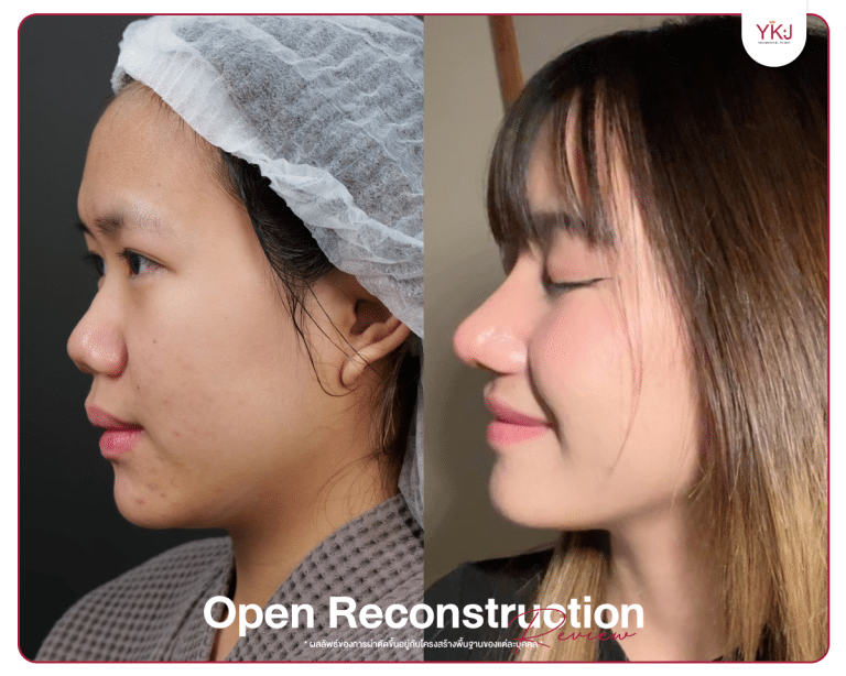 รีวิวแก้จมูก , รีวิวเสริมจมูกโอเพ่น , กระดูกซี่โครง , กระดูกอ่อนหลังหู