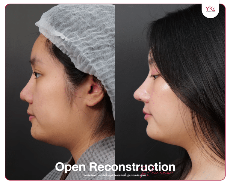 รีวิวแก้จมูก , รีวิวเสริมจมูกโอเพ่น , กระดูกซี่โครง , กระดูกอ่อนหลังหู