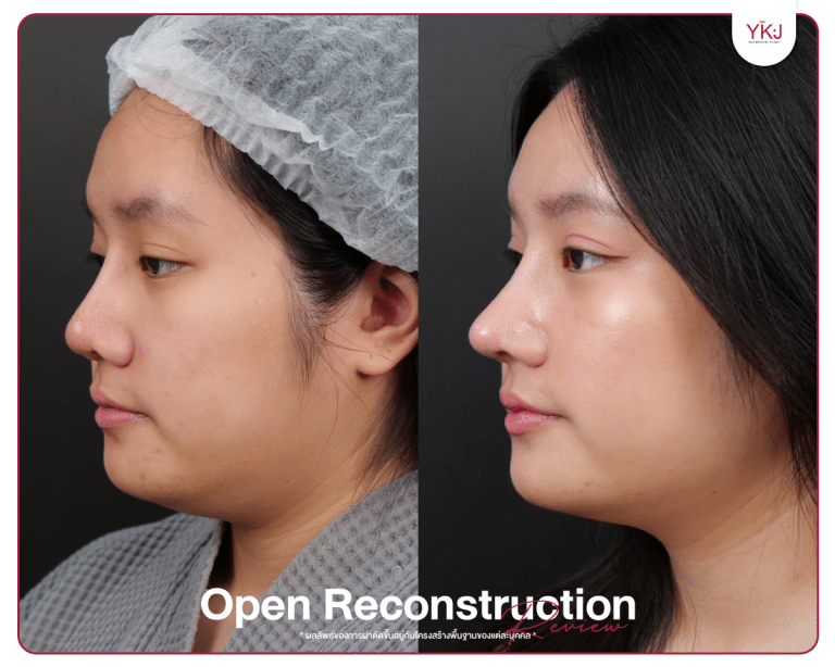 รีวิวแก้จมูก , รีวิวเสริมจมูกโอเพ่น , กระดูกซี่โครง , กระดูกอ่อนหลังหู
