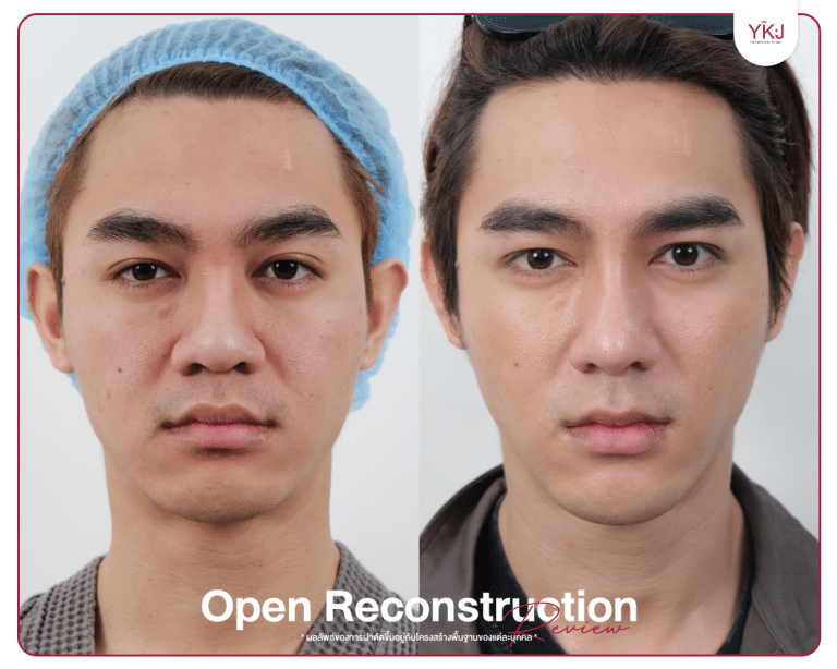 รีวิวแก้จมูก , รีวิวเสริมจมูกโอเพ่น , กระดูกซี่โครง , กระดูกอ่อนหลังหู