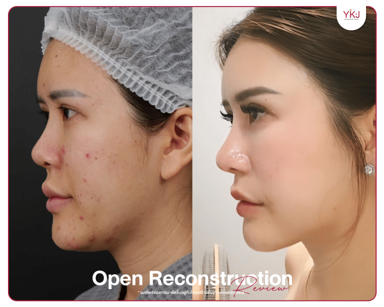 รีวิวแก้จมูก , รีวิวเสริมจมูกโอเพ่น , กระดูกซี่โครง , กระดูกอ่อนหลังหู